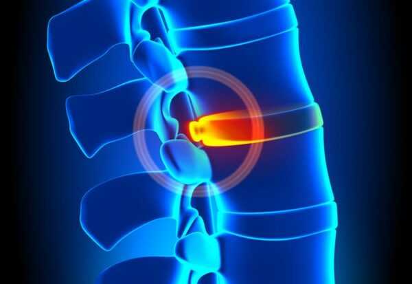 A guide to Treatment Options for a Bulging Disc or Herniated Disc